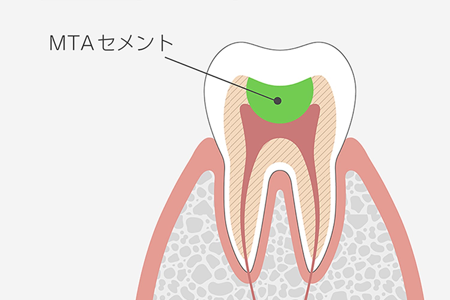 MTAセメントの活用