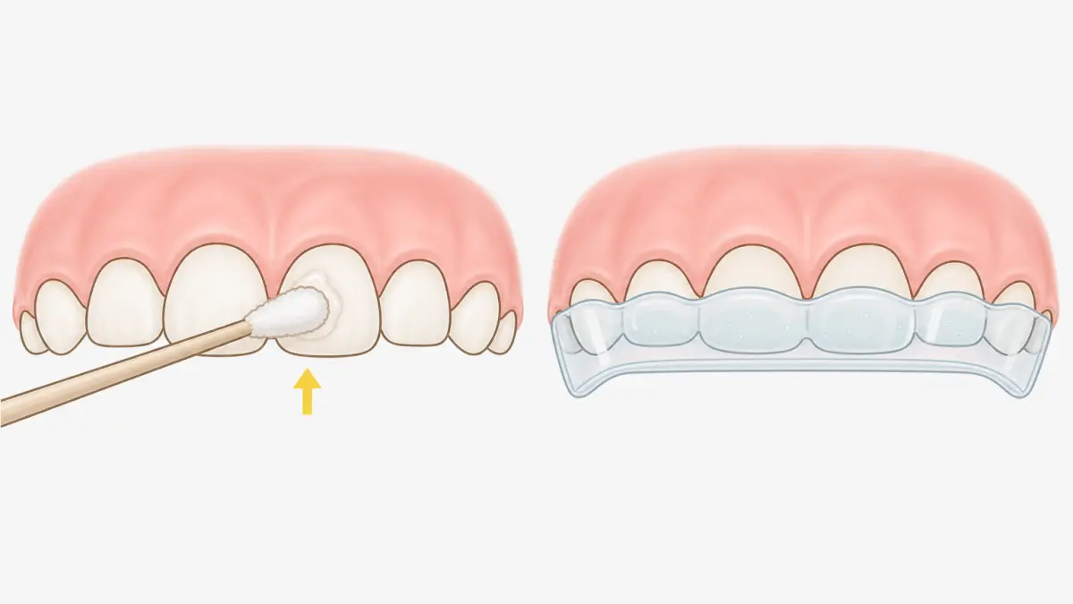綿球法とトレー法の違いを示すイラスト。うがいなしで塗布できる方法を比較